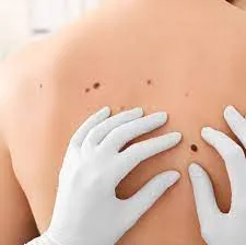 Remoção de Sinais, Cistos e Lipomas