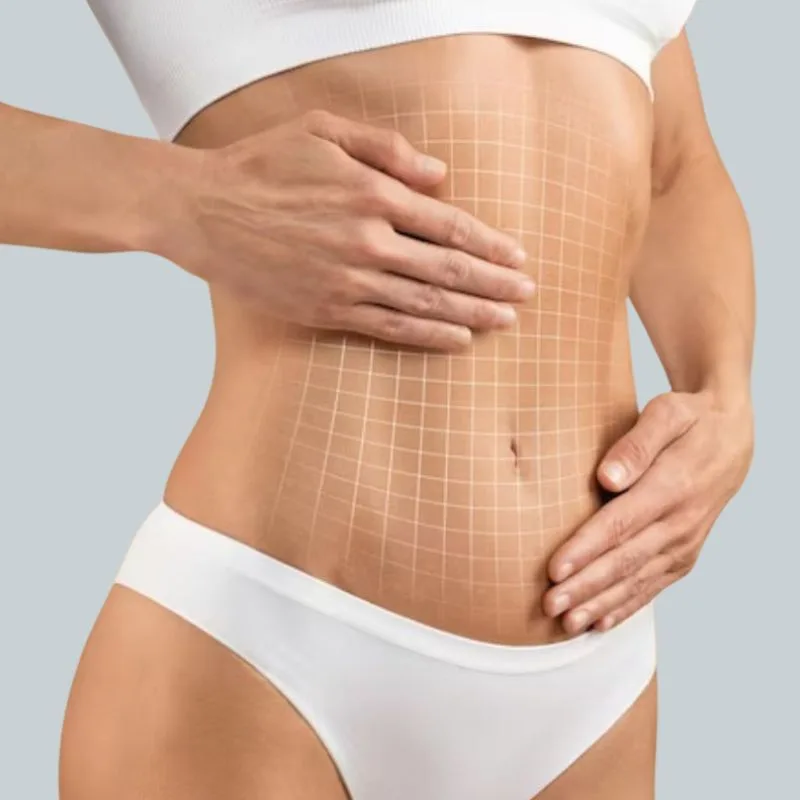 Abdominoplastia