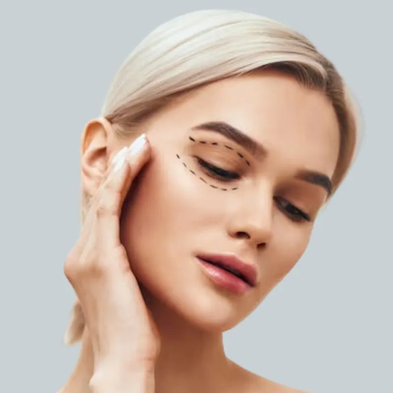 Blefaroplastia