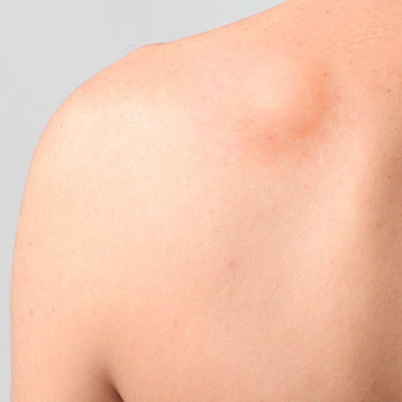 Remoção de Lipoma e Cisto Sebáceo