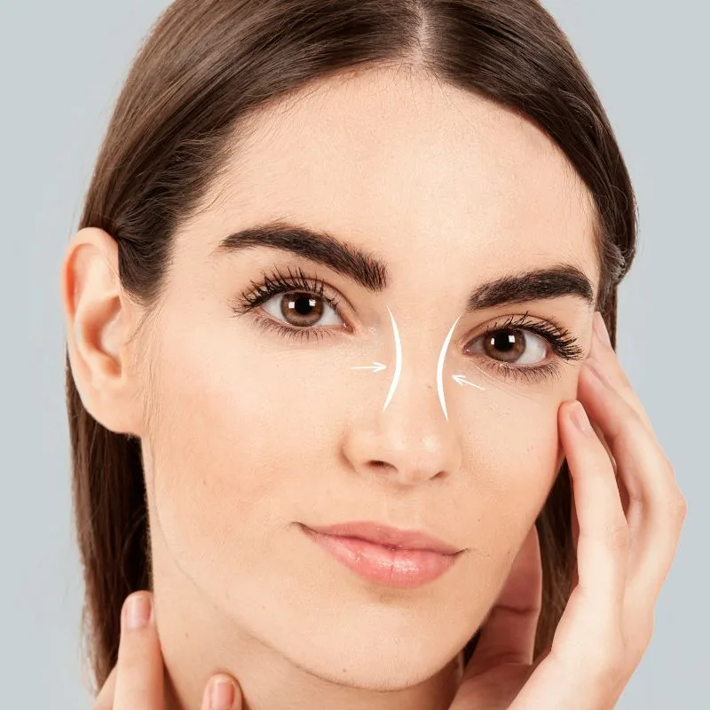 Rinoplastia